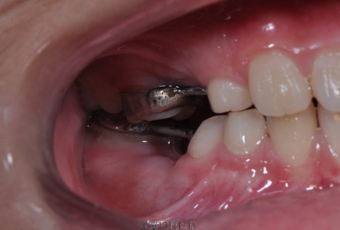 间隙保持器的佩戴有助于儿童换牙后的牙列整齐,降低因牙列不齐而需要